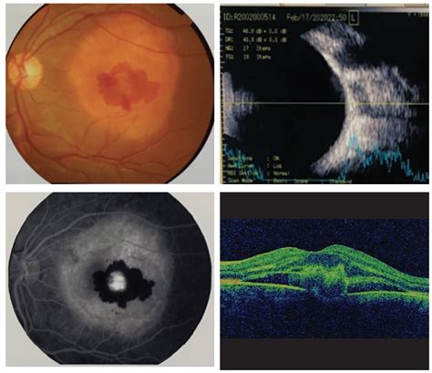 Macular Choroidal Osteoma - Retina Today