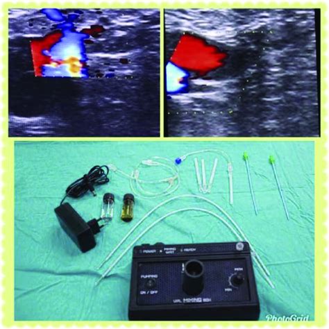 Fig. Comparative evaluation of venous reflux before and after the ...