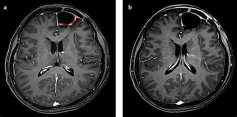 A 48 Year Old Female With Anaplastic Astrocytoma Thin Linear