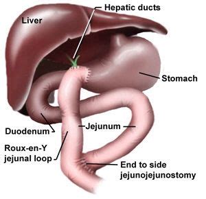 Roux En Y Choledochojejunostomy