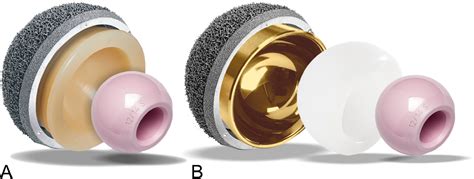 Figure 1 From Is Modular Dual Mobility Superior To Standard Bearings