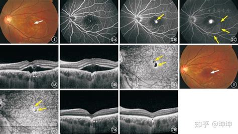 黄斑疾病 知乎