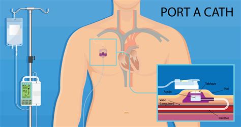 Dispositivo De Acceso Venoso Implantado Puerto OncoLink