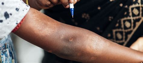 What Are The Symptoms Of Leprosy
