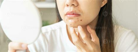 Expression worry asian young woman hand touching pustule around the