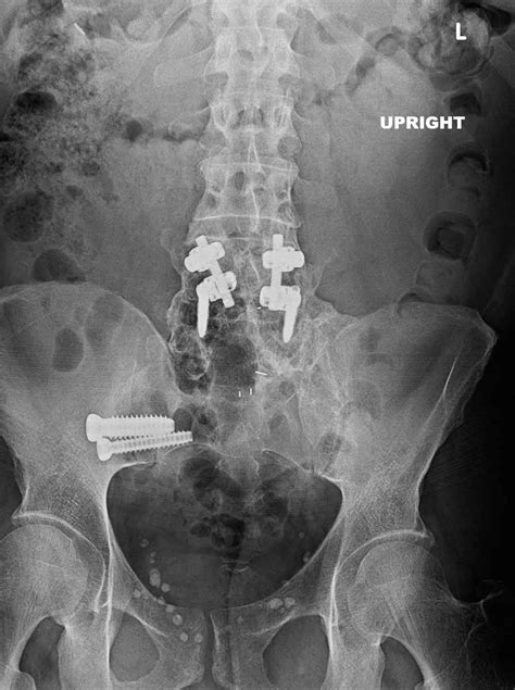 Si Joint Fusion Success Rate | Science Relief