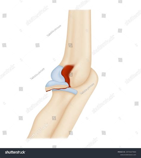 Causes Symptoms Capitellum Fracture Stock Vector (Royalty Free