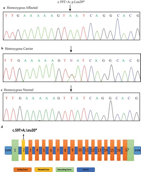 Electropherograms Representing Sanger Sequencing Of A Nonsense Variant