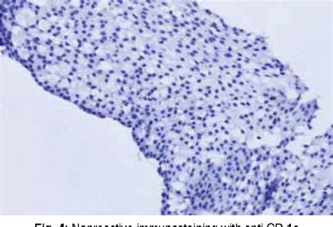 Clear Cell Variant Of Calcifying Epithelial Odontogenic Tumor Without