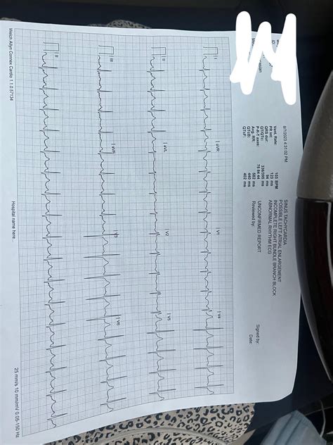 How common are these EKG results ? : r/askCardiology