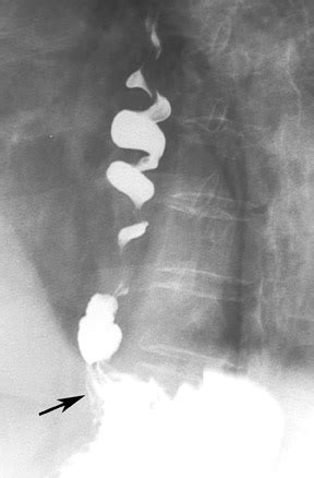 Achalasia And Diffuse Esophageal Spasm Spectrum Of Findings And