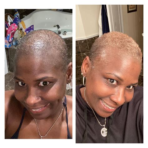 r/tressless discussions highlight new hair growth success stories 1