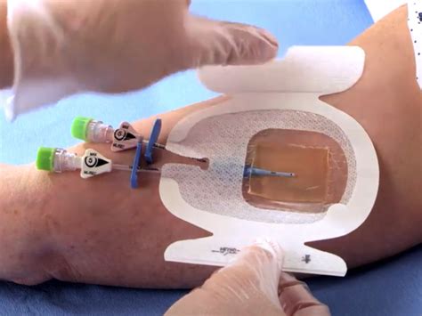 Dressing A Central Line Properly — Maimonides Emergency Medicine Residency