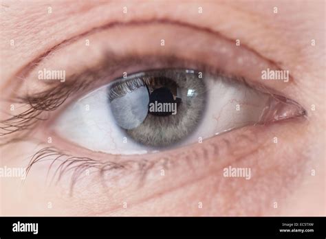 Eye Sickness Hi Res Stock Photography And Images Alamy