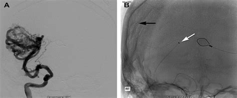 Endovascular Advances for Brain Arteriovenous Malformations : Neurosurgery