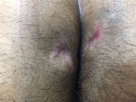 anal fistula K مركز علاج البواسير بالليزر والدوبلر بدون جراحة ولا ألم