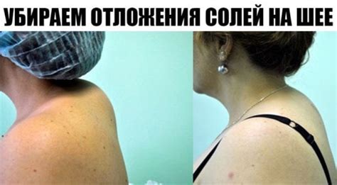 УБИРАЕМ ОТЛОЖЕНИЯ СОЛЕЙ НА ШЕЕ В области шеи сосредоточено множество ...