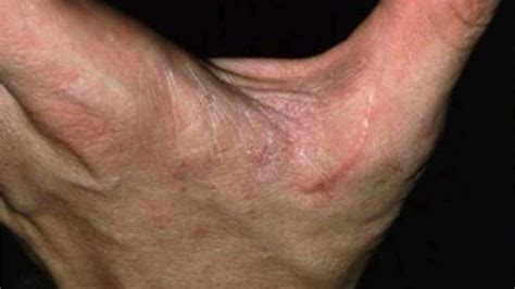 Dr Epifania Fitriana Adna Kenali Penyakit Scabies Dan Cara