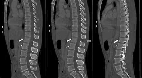 Lets Review Chance Fracture Bmj Case Reports