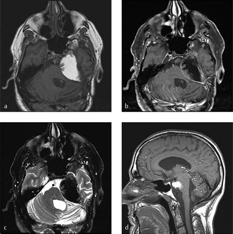 41 Epidermoids Dermoids And Other Cysts Of The Skull Base Neupsy Key