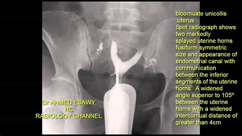 Case 100 Bicornuate Uterus Hsg Youtube