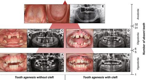 Forms of tooth agenesis. Panel of tooth agenesis (TA) forms in the ...