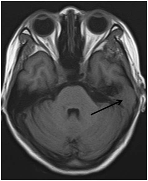 Mastoid Air Cells Mri