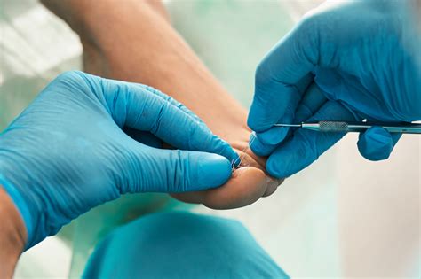 Ingrown Toenail Surgery Bunbury & Busselton