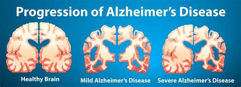 Progression Of Alzheimers Disease On Blue Background 455171 Vector Art