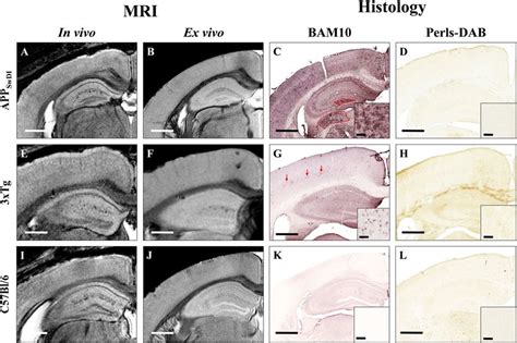 Comparison between detection of amyloid plaques by Gd-stained MRI and ...