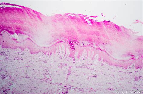 Stratified Squamous Epithelium Keratinized Kit Ng Phd