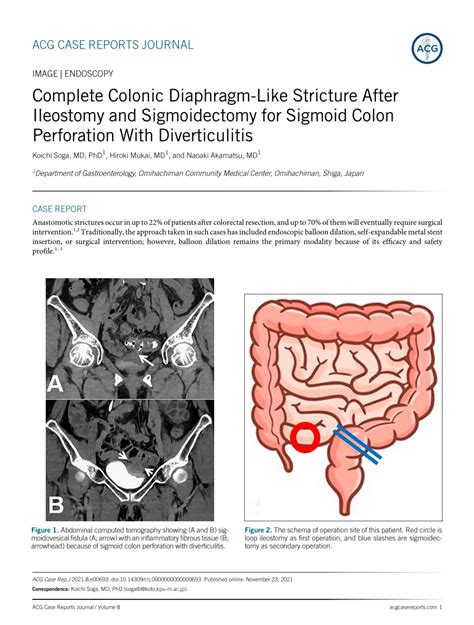 Pdf Complete Colonic Diaphragm Like Stricture After Ileostomy And Sigmoidectomy For Sigmoid