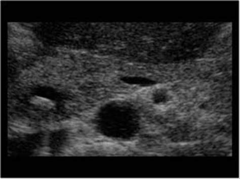 Abdomen and retroperitoneum | 1.2 Gallbladder and bile ducts : Case 1.2.15 Bile duct: Sludge and ...