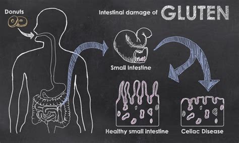 Gluten Sensitivity Vs Celiac Disease Differences And Similarities With Images Celiac