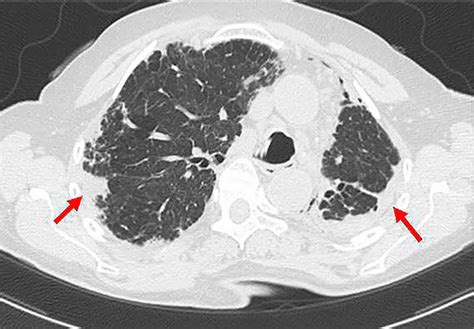 Acute Interstitial Pneumonitis Causes Symptoms Diagnosis Treatment