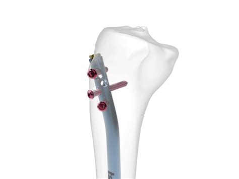 easylock tibia nail tst