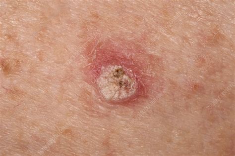 Papillomatosis Skin