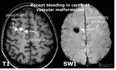 Mri Technique
