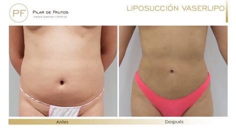 Diferencia Entre Liposuccion Y Lipoescultura Encuentra La Diferencia