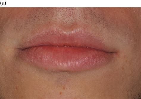 Ectopic Sebaceous Glands On Lips Lipstutorial Org