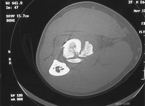 Case Report Heterotopic Ossification After Repair Of Distal Biceps