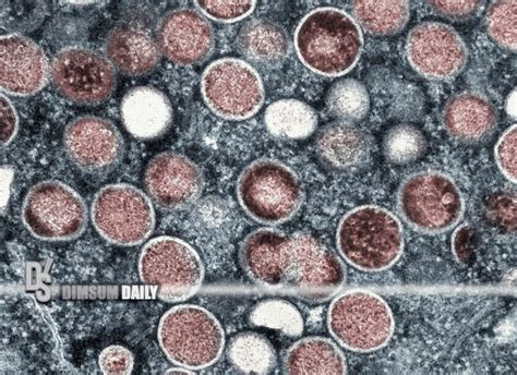 Year Old Italian Gay Man Becomes The First Patient In The World To Be Infected With Monkeypox