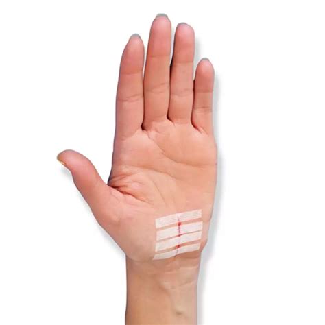 Adhesive Waterproof Steri Strip Wound Closure Strips For Wound ...