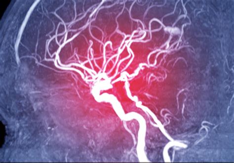 brain hemorrhage patients  treatable underlying conditions