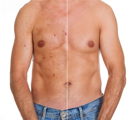 Stryx Chest Acne 8 Causes And How To Get Rid Of It