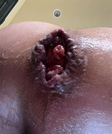 Leche Anal Estirada Xhamster