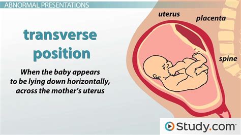 Vertex Position Fetal Position In