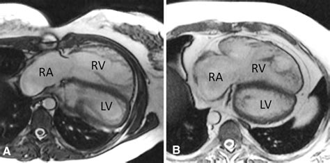 Representative Cardiac Magnetic Resonance Cmr Images From Patients