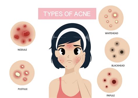 Acne Rosacea Vs Acne Vulgaris Laser & IPL Acne Treatment ⋆ Sophia