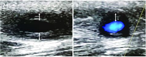 ultrasound   temporal artery  halo sign characterised
